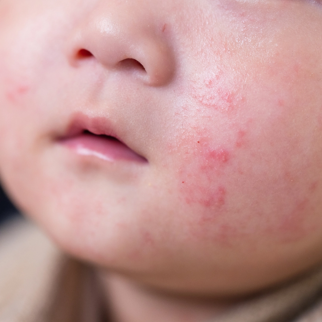 Bébé avec eczéma - Laboratoires Gilbert