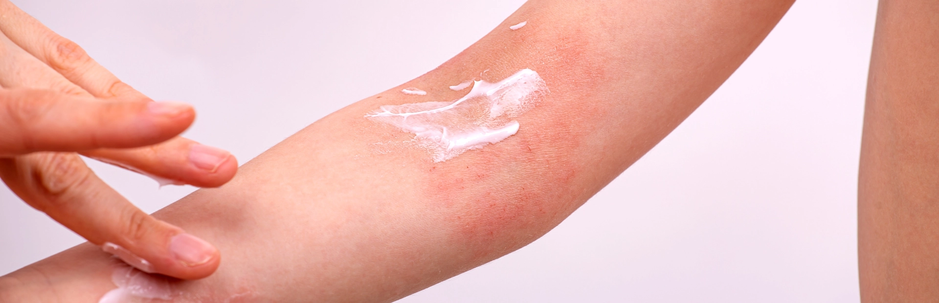 Eczéma peau - Laboratoires Gilbert