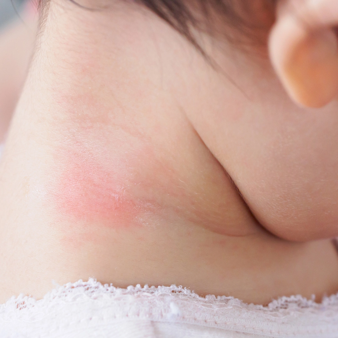 Peau réactive bébé - Laboratoires Gilbert