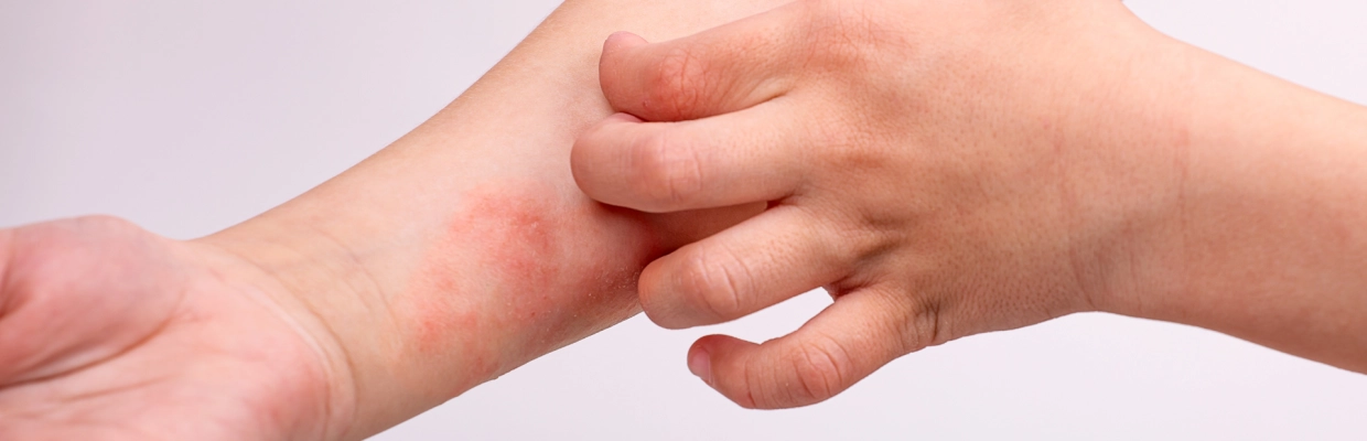 Enfant en train de se gratter - Laboratoires Gilbert